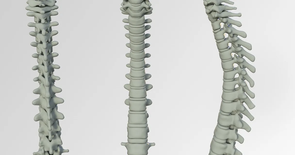 Modelo anatômico de coluna vertebral em três vistas sobre fundo claro, ilustrando o disco da coluna lombar