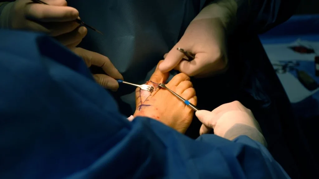 Como funciona a cirurgia moderna de joanete